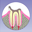 歯根の虫歯